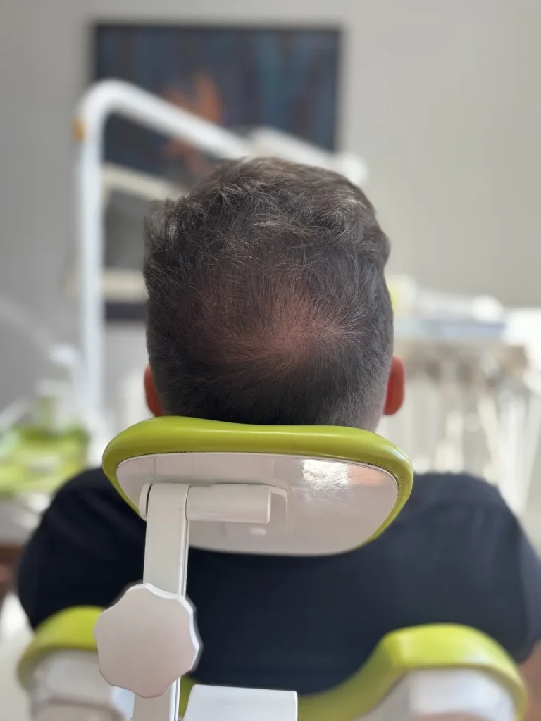 Férfi páciens fejtetője a kezelési folyamat elején, hátulnézetből